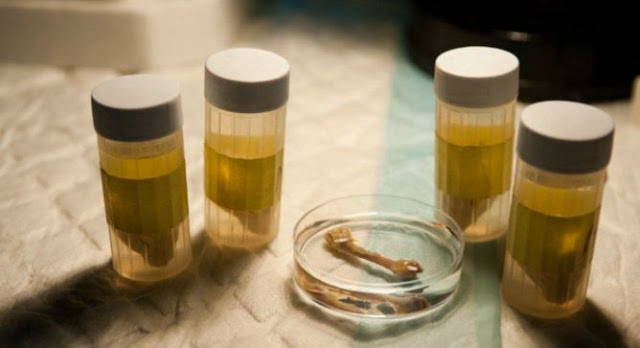 Médicos israelíes hacen crecer hueso nuevo a partir de la grasa del paciente