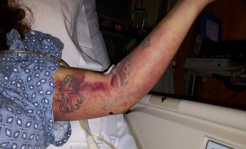 Así tenía el brazo Ángela Hernández cuando fue rescatada.