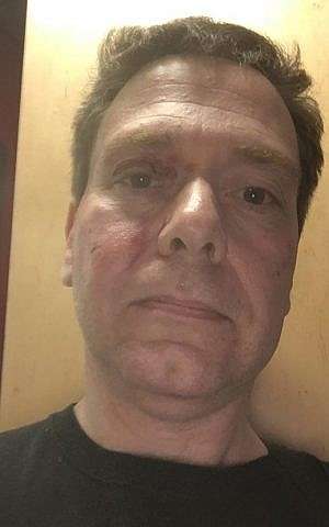 El profesor Yitzhak Melamed muestra hematomas que dice fueron causados ​​por la policía alemana (foto de Facebook)