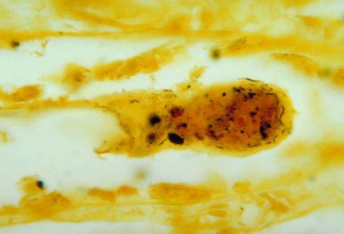 Leptospirosis en un riñón. Crédito de la foto: CDC / Dr. Martin Hicklin a través de Wikimedia