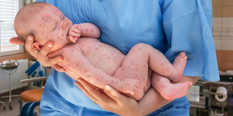 Ministerio de Salud insta a vacunarse debido al aumento masivo de casos de sarampión