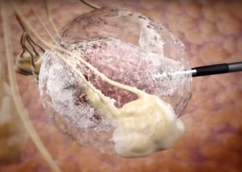 Compañía biomédica israelí IceCure informa éxito al destruir tumores con hielo en prueba de cáncer de mama