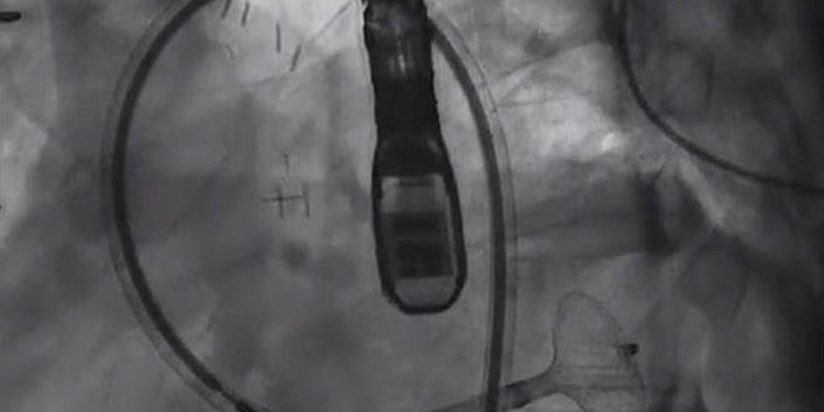 El profesor Victor Guetta, director de la Unidad de Cardiología Invasiva e Intervencionista del Centro Médico Sheba, tapó un orificio de sangrado en la arteria de un paciente de 29 años que usa un dispositivo que generalmente se usa para desbloquear arterias (captura de pantalla de YouTube)