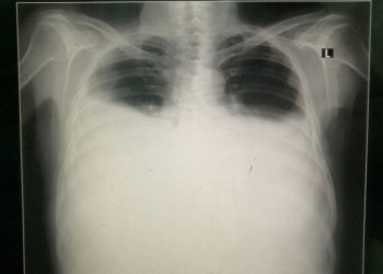 Derrame Pleural Bilateral (crédito de la foto: Wikimedia Commons)