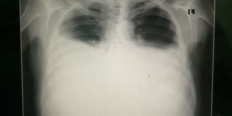 Derrame Pleural Bilateral (crédito de la foto: Wikimedia Commons)