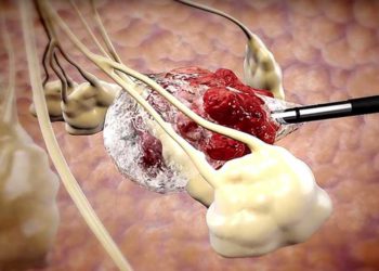 Nueva tecnología israelí es capaz de destruir tumores cancerosos