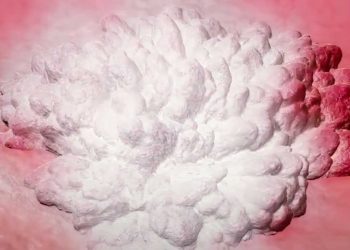 Congelando el tumor en lugar de cortarlo: Israel pionero en nuevo enfoque para el cáncer de vejiga
