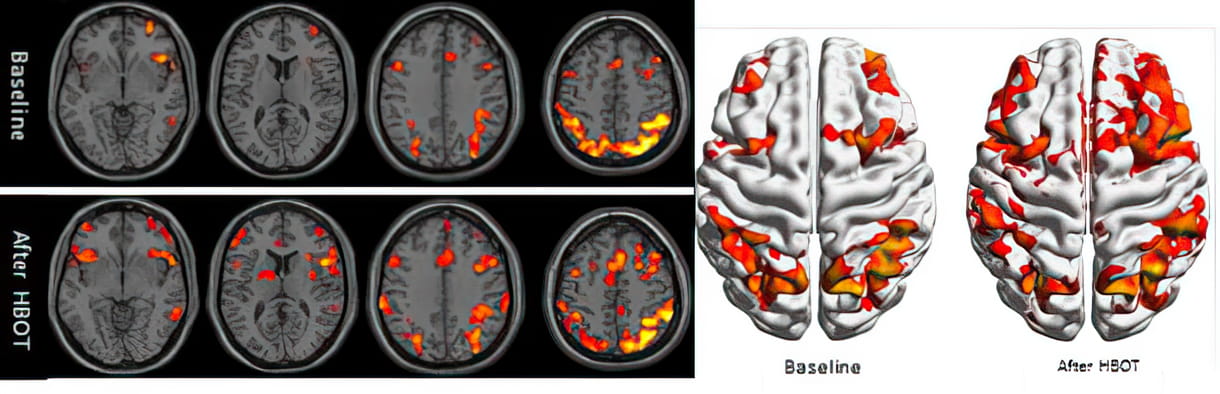 Ejemplo clínico de imágenes cerebrales funcionales por fMRI. La actividad cerebral reducida en los lóbulos frontales del cerebro y en el hipocampo mejora tras la terapia de oxígeno hiperbárico (Cortesía/ Centro Médico Shamir)