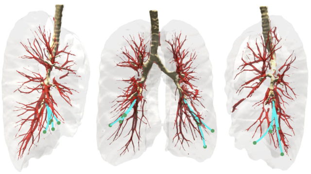 Dormir mal empeora la enfermedad pulmonar más que el tabaco