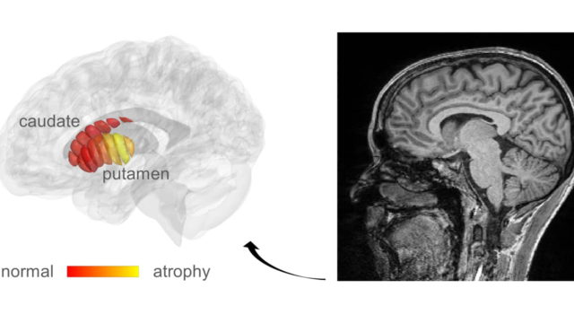 Universidad Hebrea asegura que será posible el diagnóstico temprano del Parkinson