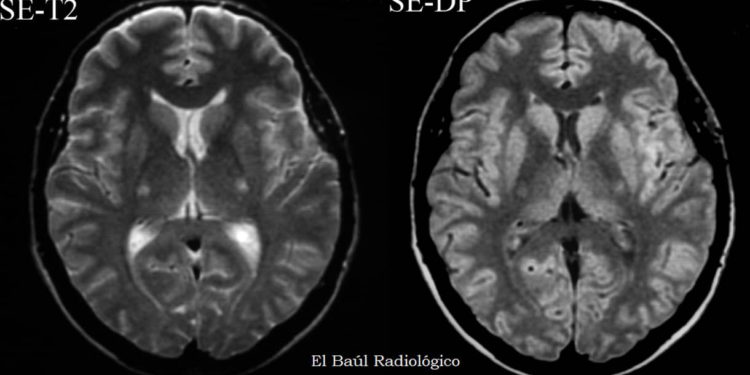 La empresas israelíes NeuroSense y NeuraLight colaboran para detectar la ELA mediante IA