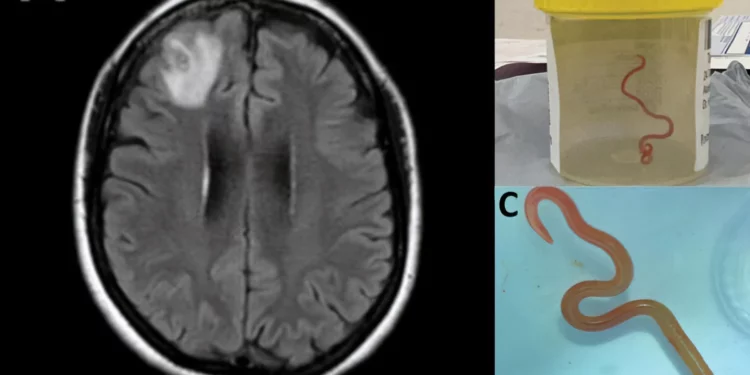 Descubren un gusano parásito en el cerebro de mujer de 64 años