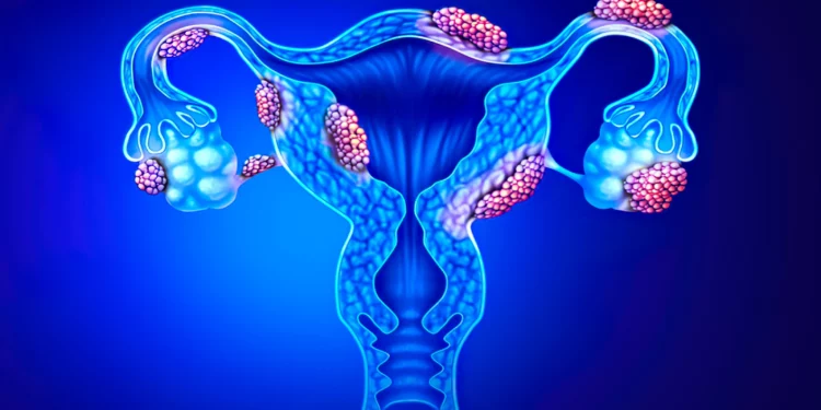 La israelí Gynica inicia un ensayo clínico para curar la endometriosis