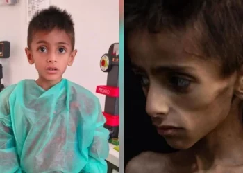 Osama al-Rakab, de 5 años, recibe tratamiento médico, a la izquierda. COGAT dice que una imagen viral de él, a la derecha, se usó para acusar falsamente a Israel de matar de hambre a los niños en Gaza. (Captura de pantalla: COGAT vía X)