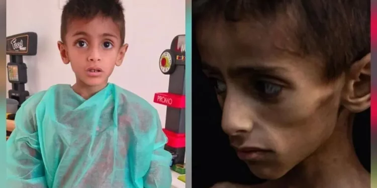 Osama al-Rakab, de 5 años, recibe tratamiento médico, a la izquierda. COGAT dice que una imagen viral de él, a la derecha, se usó para acusar falsamente a Israel de matar de hambre a los niños en Gaza. (Captura de pantalla: COGAT vía X)