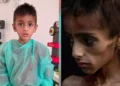 Osama al-Rakab, de 5 años, recibe tratamiento médico, a la izquierda. COGAT dice que una imagen viral de él, a la derecha, se usó para acusar falsamente a Israel de matar de hambre a los niños en Gaza. (Captura de pantalla: COGAT vía X)