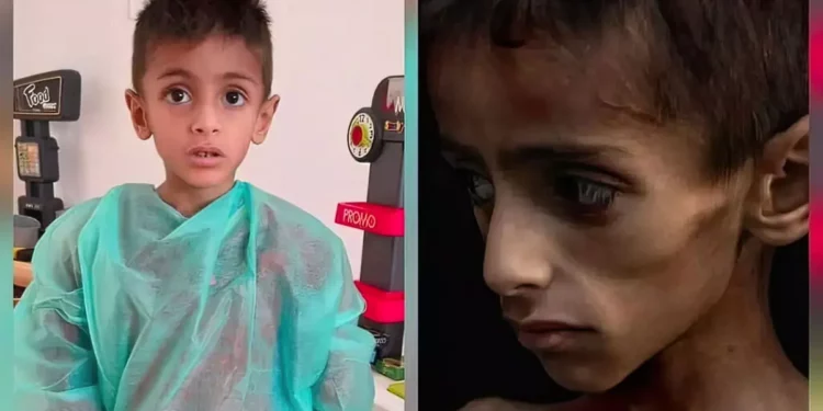 Osama al-Rakab, de 5 años, recibe tratamiento médico, a la izquierda. COGAT dice que una imagen viral de él, a la derecha, se usó para acusar falsamente a Israel de matar de hambre a los niños en Gaza. (Captura de pantalla: COGAT vía X)